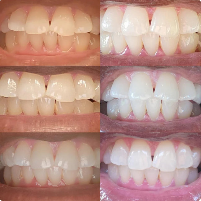 Instawhite™ Teeth Whitening Serum Pen